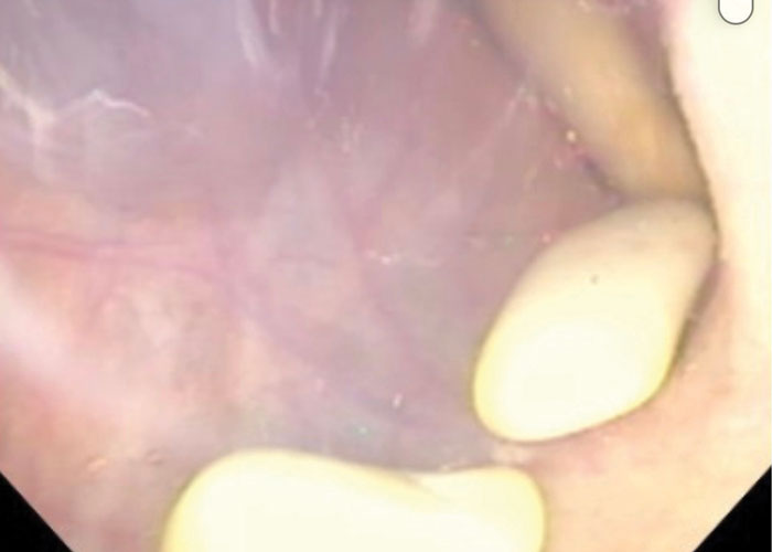 Guttural pouch endoscopy showing chondroids within purulent discharge