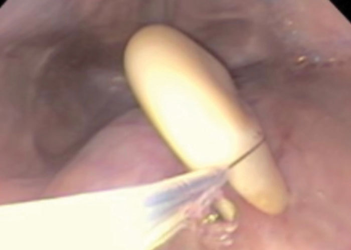 Guttural pouch endoscopy showing chondroids within purulent discharge